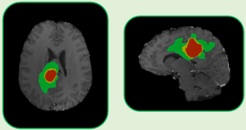 https://raw.githubusercontent.com/MiquelGomezCorral/ARA-Medical-MissingData-Robust-Model/main/readme-images/radiomic_segmentation.png