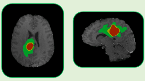 https://raw.githubusercontent.com/MiquelGomezCorral/ARA-Medical-MissingData-Robust-Model/main/readme-images/radiomic_segmentation_169.png